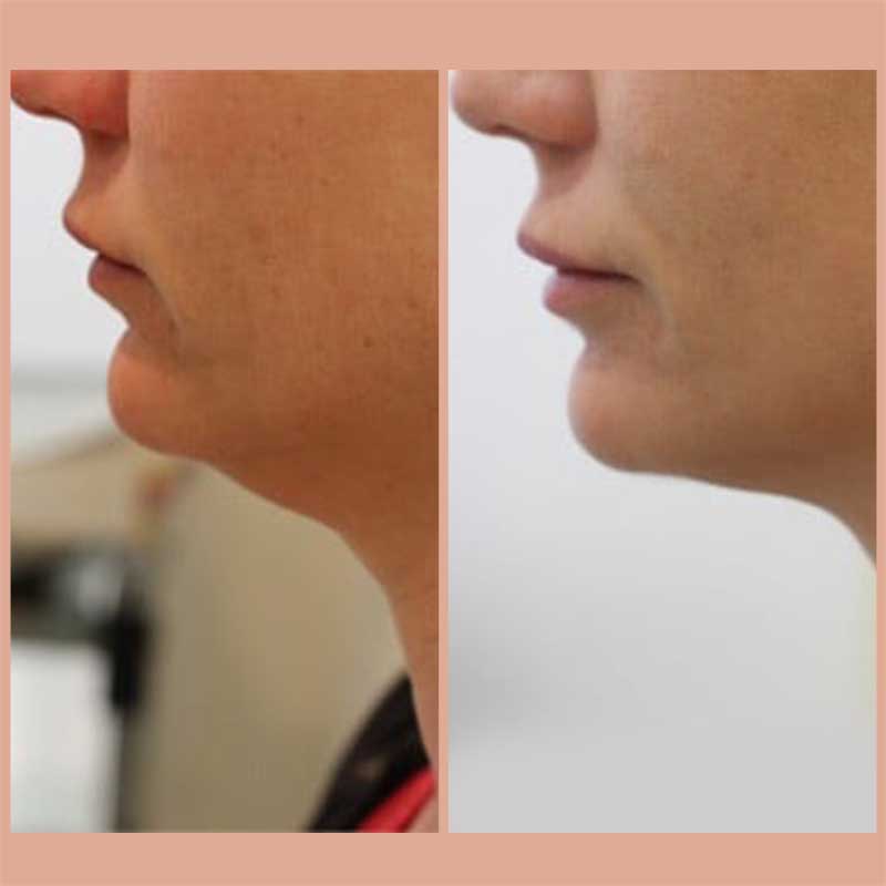 Lipodissolve Before And After Photos Of A Double Chin Fat Reduction ...