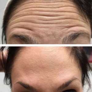 Anti-Wrinkle Result