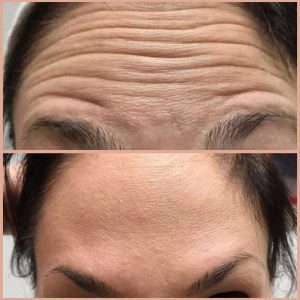 Forehead Injections Result