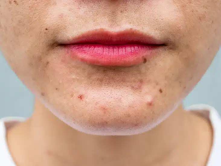 female-face-acne-732-549-feature-thumb-732x549 (1)