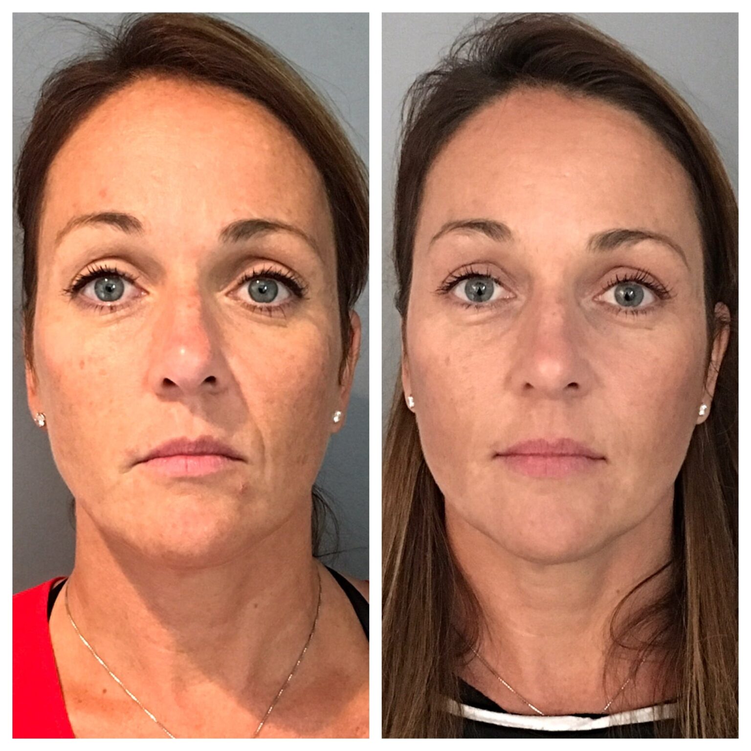Lines + Jowls Treatment with Dermal Filler Brisbane Hamilton Skin Clinic